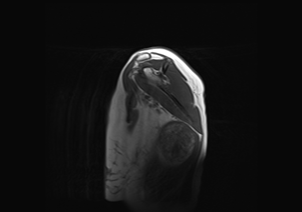 Figure 5 for case Bilateral elastofibroma dorsi